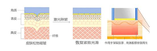 除皱选择点阵激光剥脱与非剥脱,一直做激光除皱会有副作用吗