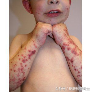 腿脚起红点是过敏性紫癜吗,小腿上出现小红点过敏性紫癜