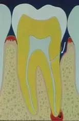 厉害了！她用缝衣针来治疗牙疼