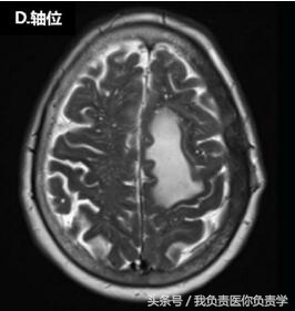 每日病例：头顶是莫名其妙长了个“包”，来看看医生怎么诊断？