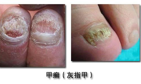 这一个小处方能搞定你长久不愈的灰指甲