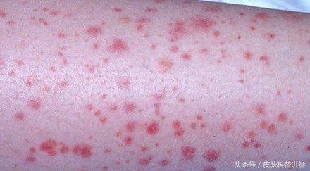 过敏性紫癜小腿胳膊有红点,过敏性紫癜一走路小腿就起红点