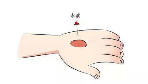 中药热敷怎么样才能不烫伤,治疗白斑的中药可以泡脚吗