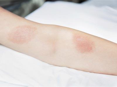 过敏脸红红的,过敏皮肤红红的