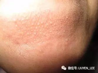 《保养专题》不痛不痒但看了就碍眼的粉刺