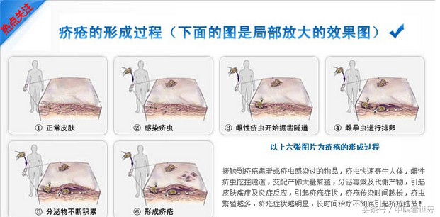 湿疹会传染吗要怎么治,湿疹会反复发作不会传染