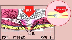 褥疮易缠身防患于未然