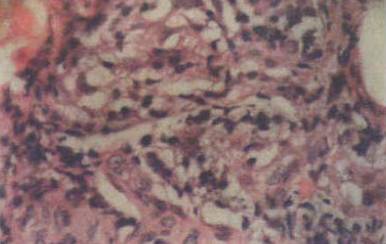 有一种病叫红斑丘疹,边界清晰发痒红斑有丘疹是湿疹吗