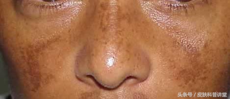 身上的褐斑慢慢长大了该怎么办,褐斑的原因及治疗方法