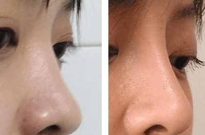 鼻子做假体多久才能恢复正常,鼻子做假体增生了怎么办