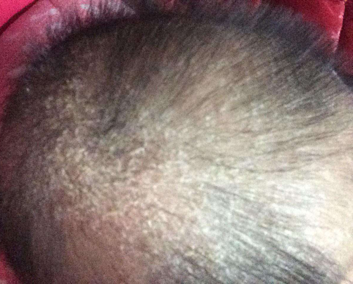 宝宝头上长很多污垢,宝宝头上污垢去除后又长多了