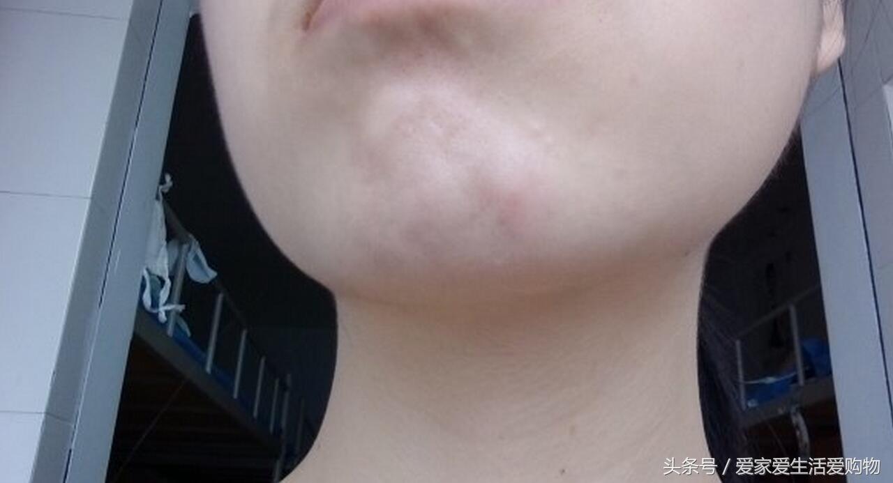 下巴长粉刺的正确消除方法,下巴长粉刺的原因和改善方法女生