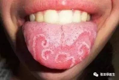 宝宝地图舌怎么办,宝宝地图舌怎么调理脾胃