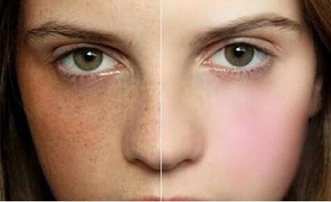 看脸的世界，你还满脸斑？