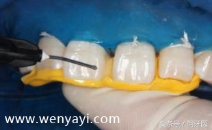门牙有缝是什么说法,门牙有缝怎么办如何补救
