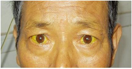 “小引流大作用”救命的胆道外引流管治疗晚期肿瘤性黄疸