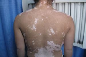 药离子和308治疗白癜风效果怎么样,308激光治疗白癜风医保报销吗