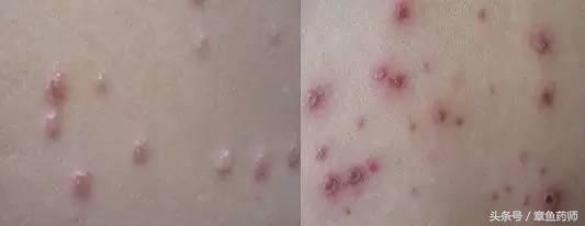 注意水痘高发期这些知识需知,小心传染病高发期