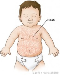 幼儿急疹的斑丘疹多久消失,幼儿急疹是否有痒的案例