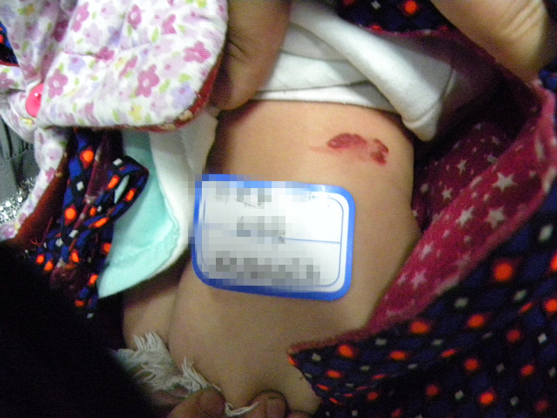 新生儿额头有块红的是啥,新生儿额头出现一片泛红