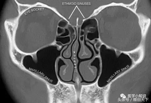 鼻窦炎引起头痛怎么治疗,鼻窦炎的症状及食疗视频播放