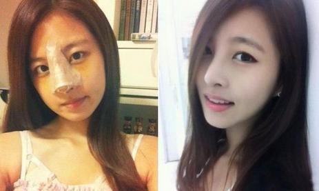 耳软骨隆鼻垫鼻尖缺点,隆鼻耳软骨垫鼻尖发白