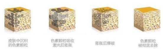 肝斑和褐青色斑的区别,褐青色斑和黄褐斑哪个严重