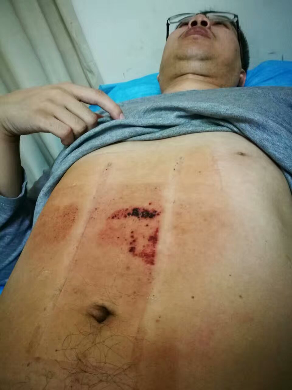 带状疱疹有没有一周痊愈的,带状疱疹一个疗程就好了吗