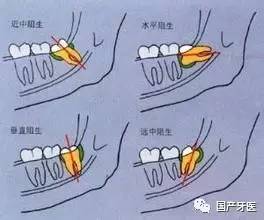 拔智齿瘦了20斤,拔完智齿变成了瓜子脸