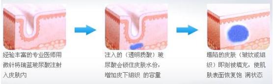 如何去除鱼尾纹的方法图解,鱼尾纹显老的方法