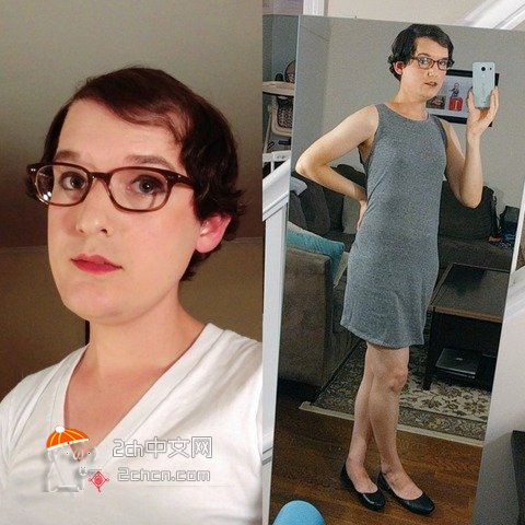 秃头大叔服用雌性激素,秃头男吃雌激素一年