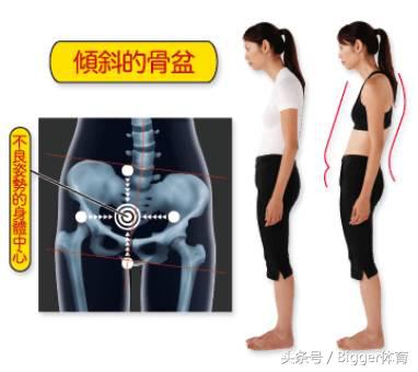产后骨盆倾斜对女性危害,骨盆前倾对跑步的影响