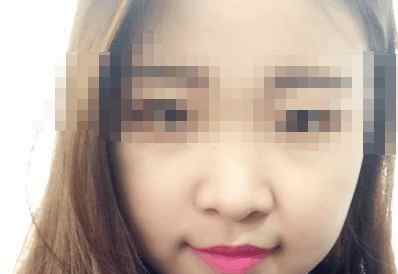 有多少人隆鼻后悔了,隆鼻的十大猫腻