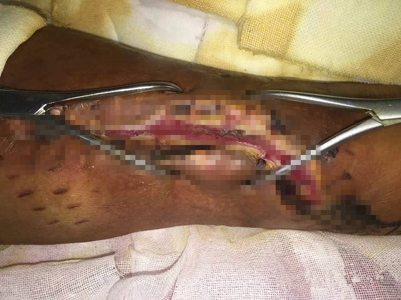 术后刀口露钢板不愈合中医疗法,术后伤口有个小洞一直不愈合