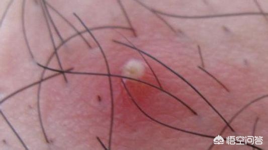 夏季多发皮肤病有哪些？什么是阴毛囊炎？