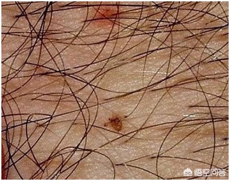 夏季多发皮肤病有哪些？什么是阴毛囊炎？