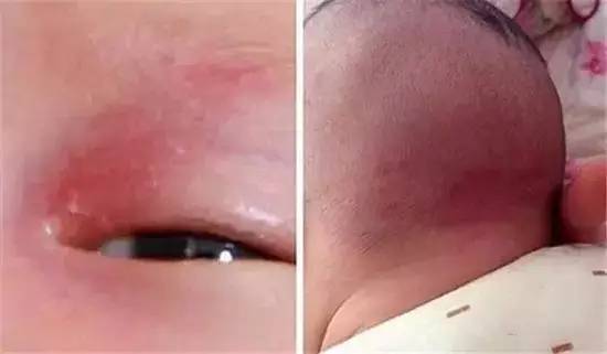 哪些胎记有危险,宝宝胎记是什么原因造成的