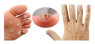 妙妙妙!5件日常用品祛除寻常疣