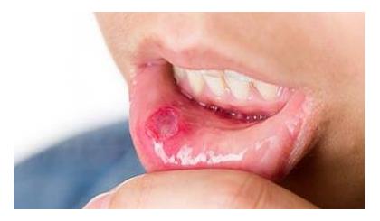 有一种疼叫口腔溃疡,重度口腔溃疡非常痛怎么回事