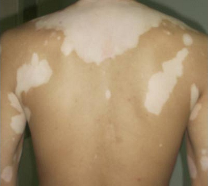 各种类型的白癜风的治疗,一种草治白癜风