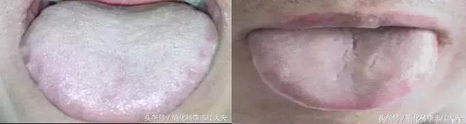 反流食管炎加萎缩性胃炎中医治疗,反流性食管炎中医把脉能看出来吗