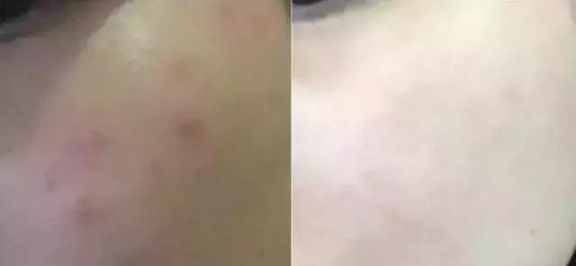 水油不平衡长痘适合的护肤品,适合混油皮长痘的护肤品