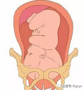 分娩最好的方法,顺产怎么分娩最快最有效