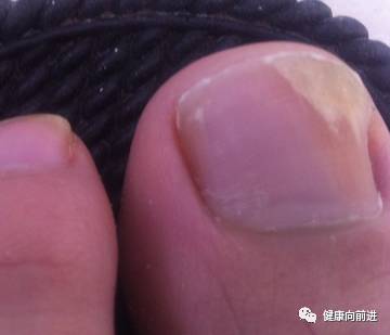 涨姿势一招让你辨别是不是肩周炎,各种类型的灰指甲