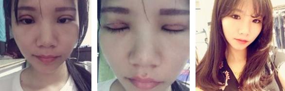 做双眼皮是如何打麻药的,其实做双眼皮没想象中那么疼