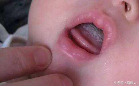 宝宝舌苔两边发白中间发红,宝宝舌苔有两块缺陷