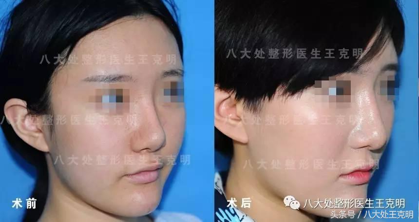 假体隆鼻透光怎么消除,假体隆鼻硅胶有可能立着吗