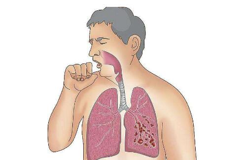 积食咳嗽的症状和治疗方法简单的,咳嗽喉痉挛性发音障碍症状及治疗