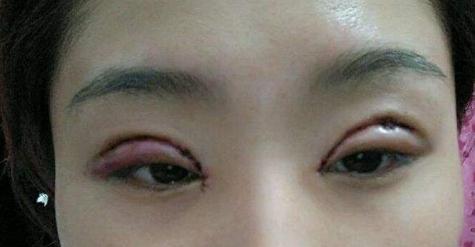 开眼角一个月还是疼,开眼角一个月还是肿需要注意什么