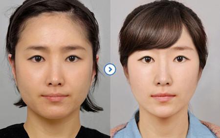 婴儿肥可以瘦下来吗？这样做婴儿肥减下去就很简单